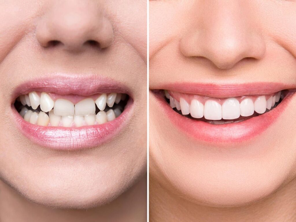 Smile Designing